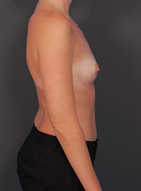 Female body, before Breast Augmentation-with Implant treatment, r-side view, patient 37