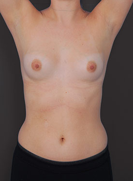 Female body, before Breast Augmentation-with Implant treatment, front view (hands up), patient 39