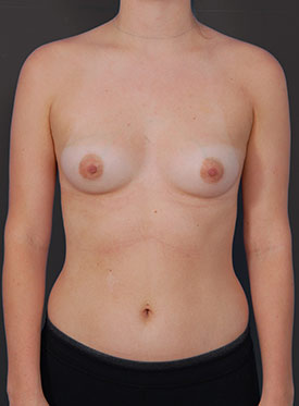 Female body, before Breast Augmentation-with Implant treatment, front view, patient 39
