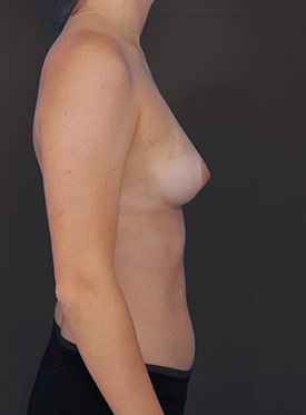 Female body, before Breast Augmentation-with Implant treatment, r-side view, patient 39