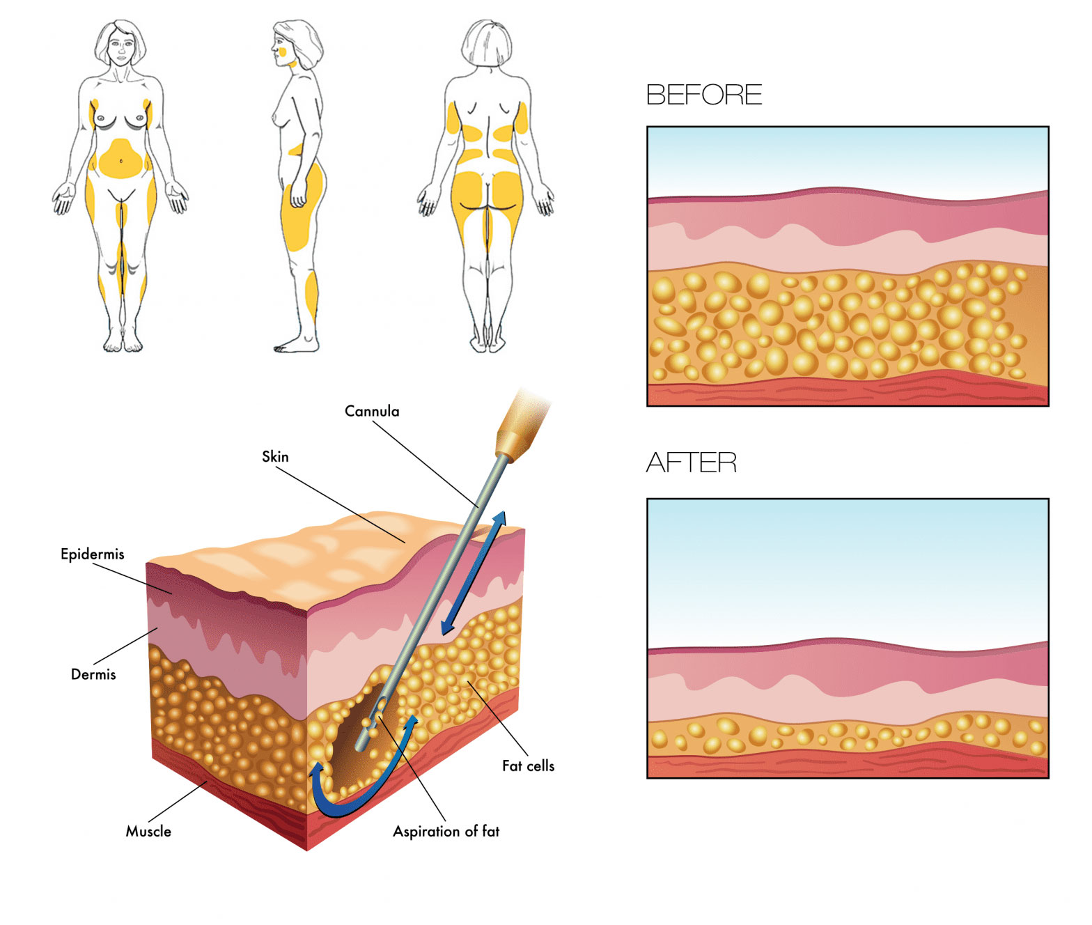 LIPOSUCTION EXPLAINED