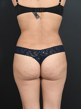 Woman's body, after brazilian butt lift treatment, back side view, patient 2