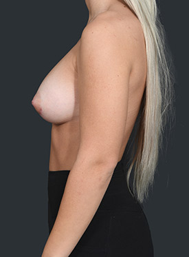 Female body, after Breast Augmentation-with Implant treatment, l-side view, patient 41