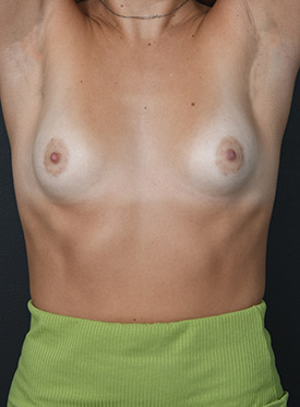 Female body, before reast Augmentation-with Implant treatment, front view (hands up), patient 41