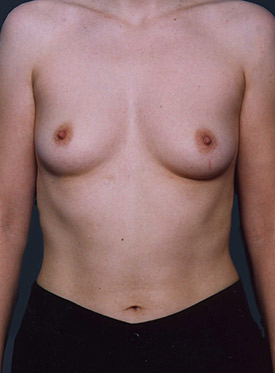 Female body, before Breast Augmentation-with Implant treatment, front view, patient 42