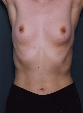 Female body, before Breast Augmentation-with Implant treatment, front view (hands up), patient 42