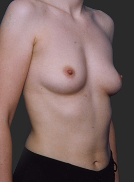 Female body, before Breast Augmentation-with Implant treatment, r-side oblique view, patient 42