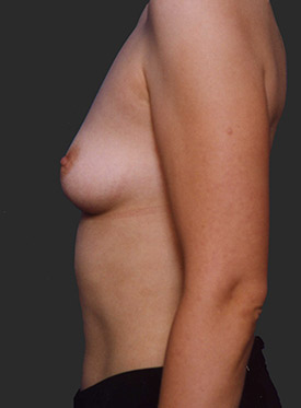 Female body, before Breast Augmentation-with Implant treatment, l-side view, patient 42
