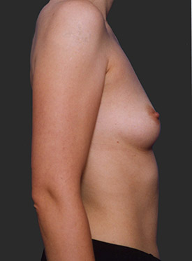 Female body, before Breast Augmentation-with Implant treatment, r-side view, patient 42