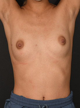 Female body, before Breast Augmentation-with Implant treatment, front view (hands up), patient 43
