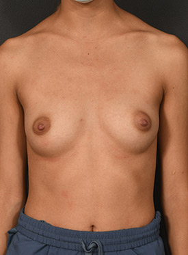 Female body, before Breast Augmentation-with Implant treatment, front view, patient 43
