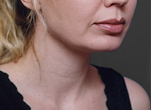 Woman's face, after Chin Implant treatment, r-side oblique view, patient 11
