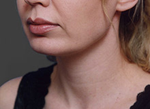 Woman's face, after Chin Implant treatment, l-side oblique view, patient 11