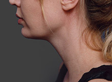 Woman's face, after Chin Implant treatment, l-side view, patient 11