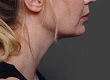 Woman's face, after Chin Implant treatment, r-side view, patient 11