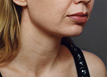 Woman's face, before Chin Implant treatment, r-side oblique view, patient 11