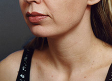 Woman's face, before Chin Implant treatment, l-side oblique view, patient 11