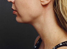 Woman's face, before Chin Implant treatment, l-side view, patient 11