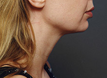 Woman's face, before Chin Implant treatment, r-side view, patient 11