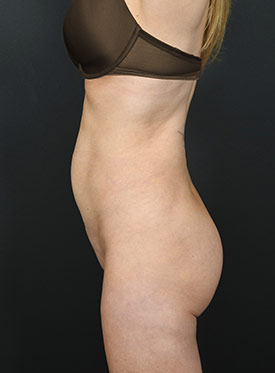 Woman's body, before thummy tuck treatment, l-side view, patient 18