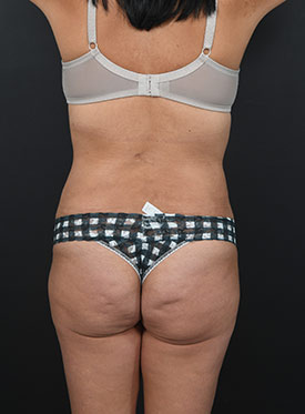 Woman's body, after thummy tuck treatment, back side view, patient 19