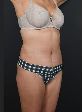 Woman's body, after thummy tuck treatment, r-side oblique view, patient 19