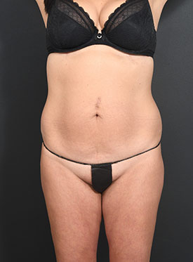 Woman's body, before thummy tuck treatment, front view, patient 19