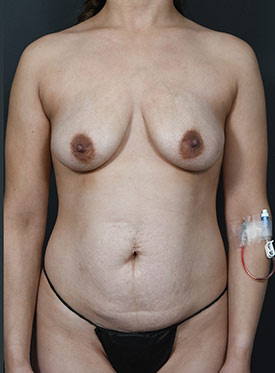 Female body, before Mastopexy Breast Lift treatment, front view, patient 30