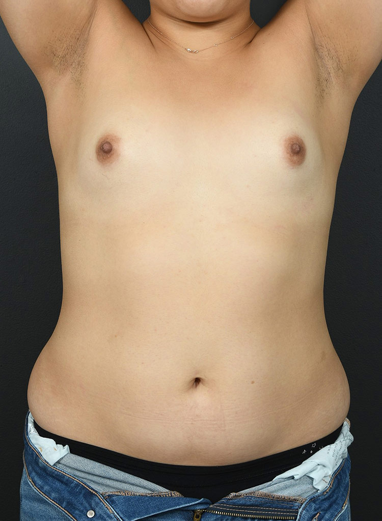 Woman's body, before Breast Augmentation-with Implant treatment, front view, patient - 44