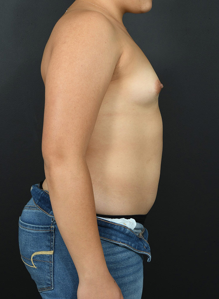 Woman's body, before Breast Augmentation-with Implant treatment, r-side view, patient - 44