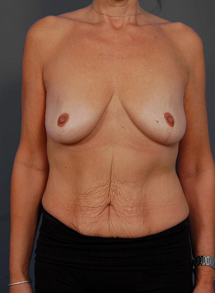 Female body, before Mastopexy Breast Lift treatment, front view, patient 32