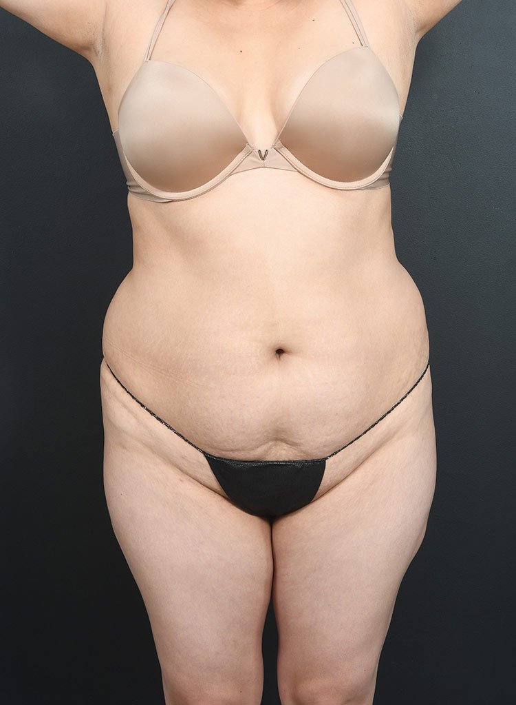 Woman's body, before liposuction treatment, front view, patient 14