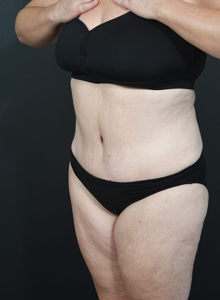 Woman's body, after thummy tuck treatment, l-side oblique view, patient 12