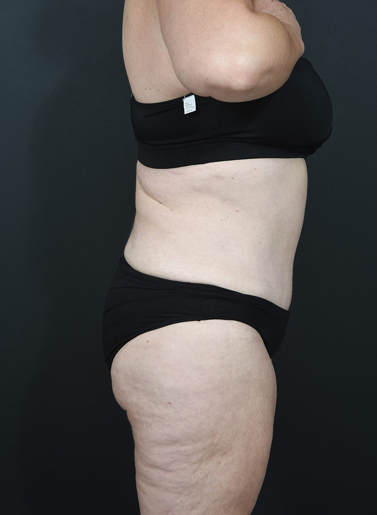 Woman's body, after thummy tuck treatment, r-side view, patient 12