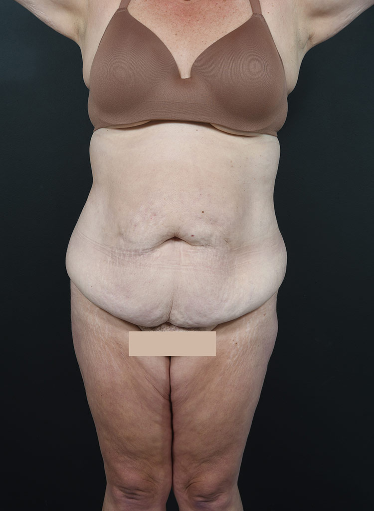 Woman's body, before thummy tuck treatment, front view, patient 12
