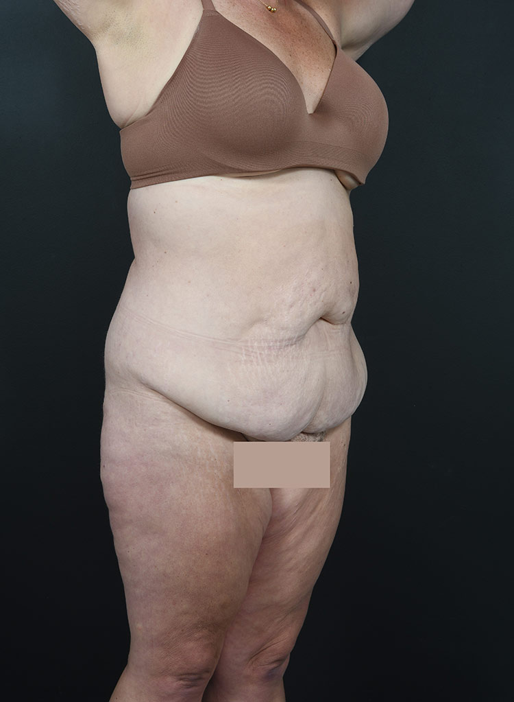 Woman's body, before thummy tuck treatment, r-side oblique view, patient 12