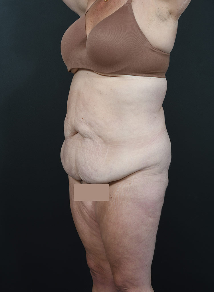 Woman's body, before thummy tuck treatment, l-side oblique view, patient 12