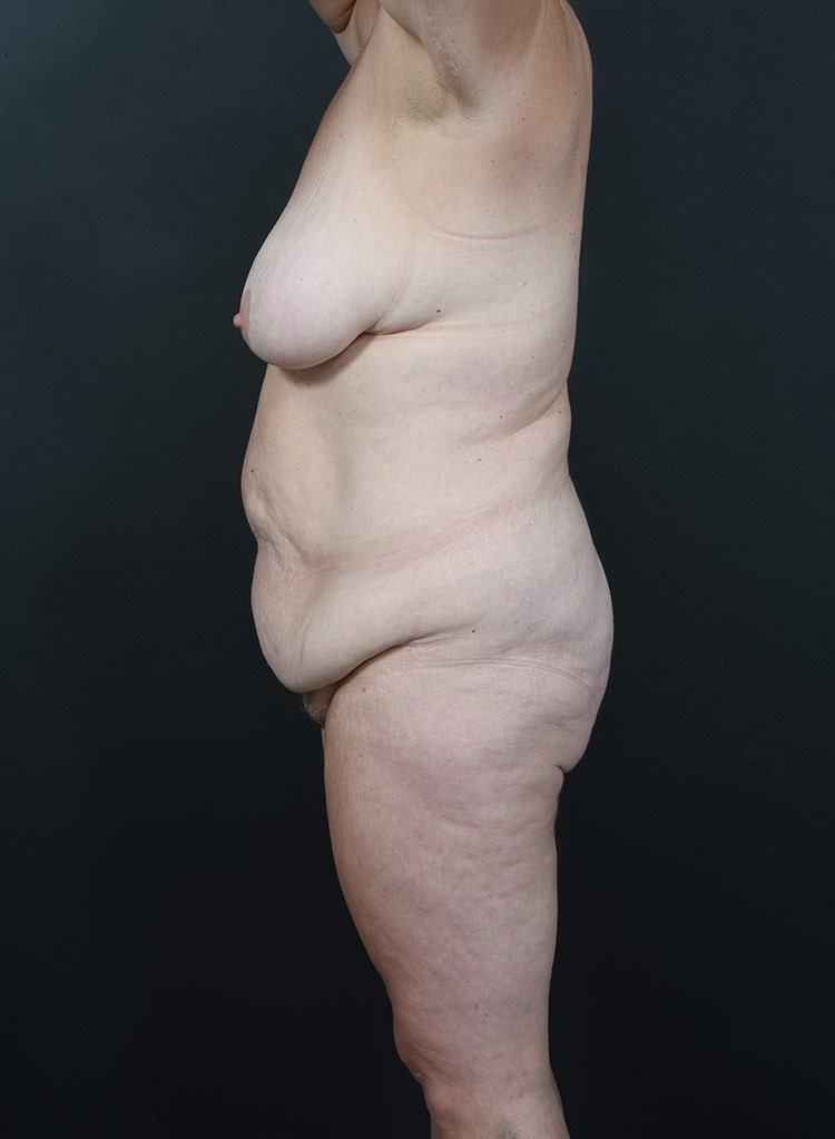 Woman's body, before thummy tuck treatment, l-side view, patient 12