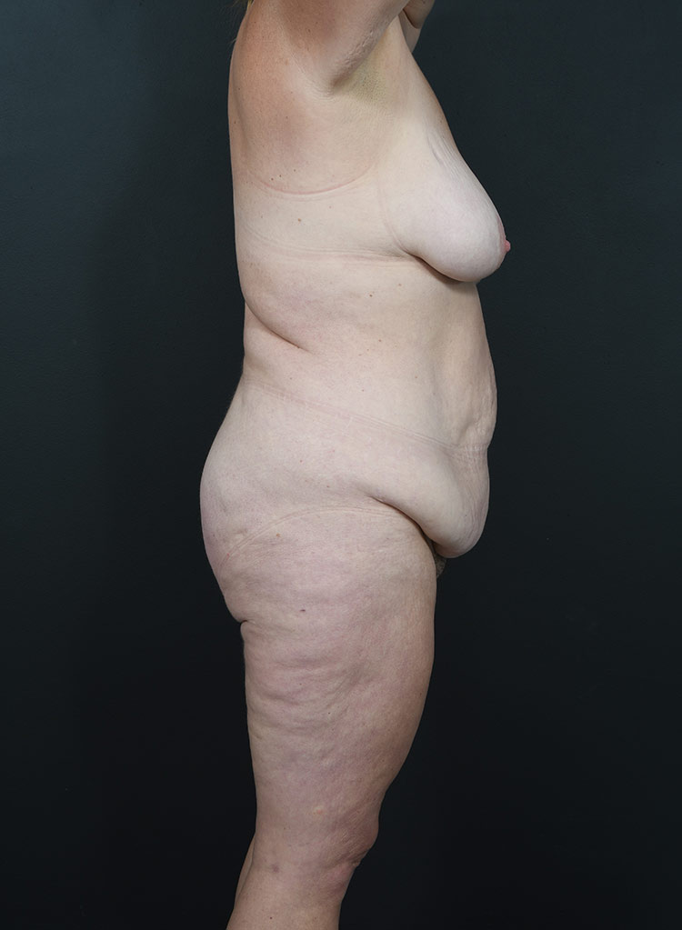 Woman's body, before thummy tuck treatment, r-side view, patient 12