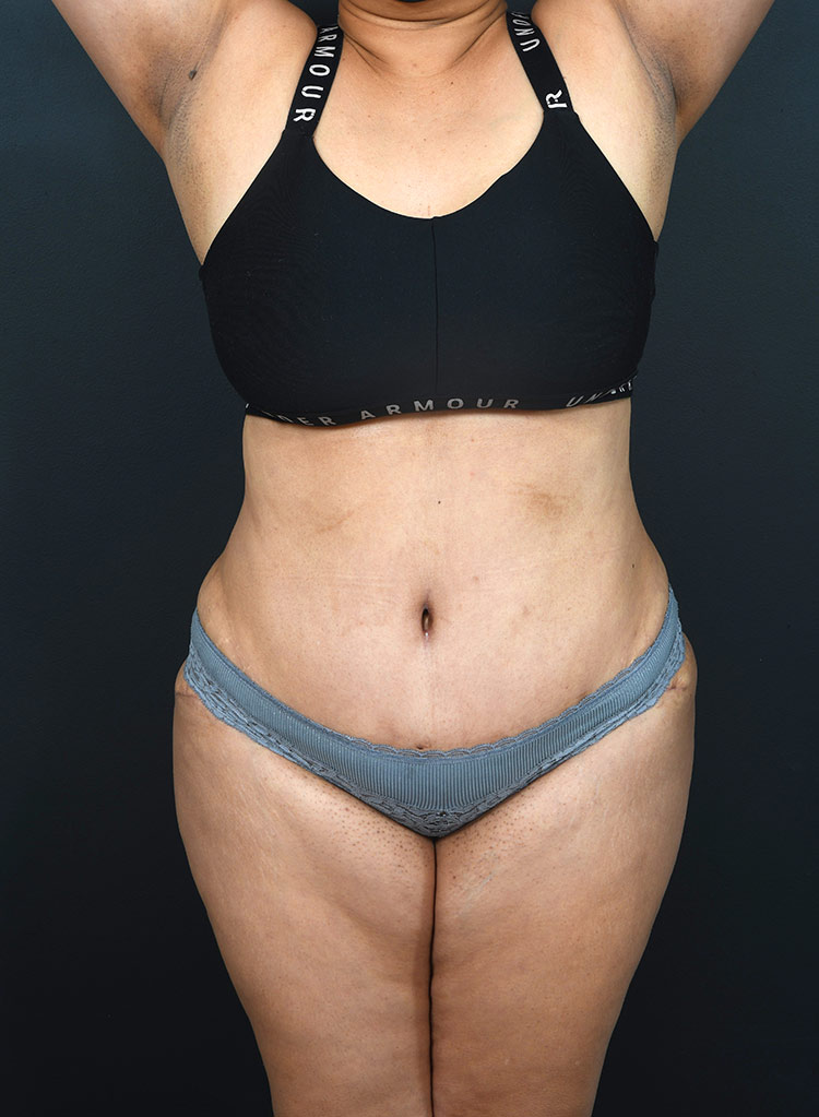 Female body, after Abdominoplasty treatment, front view, patient 13