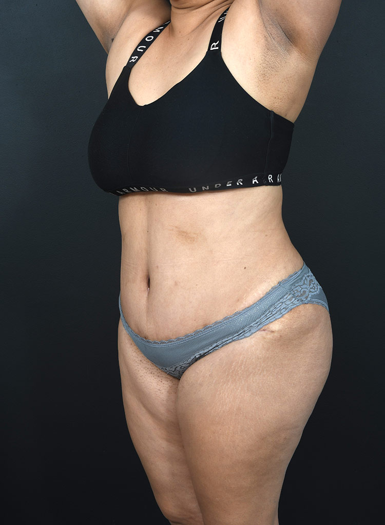 Female body, after Abdominoplasty treatment, l-side oblique view, patient 13