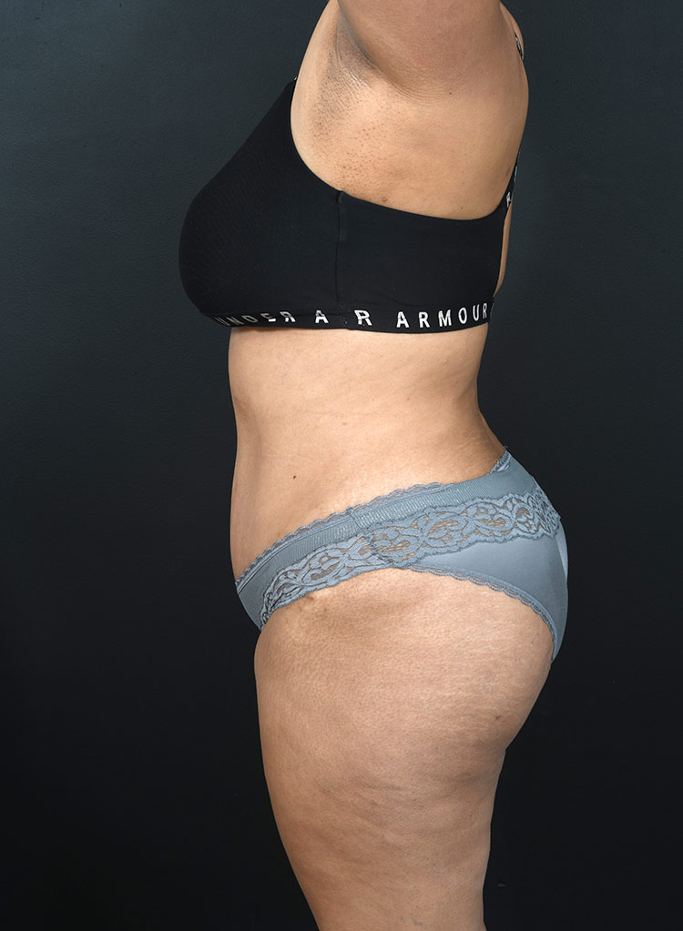 Female body, after Abdominoplasty treatment, l-side view, patient 13