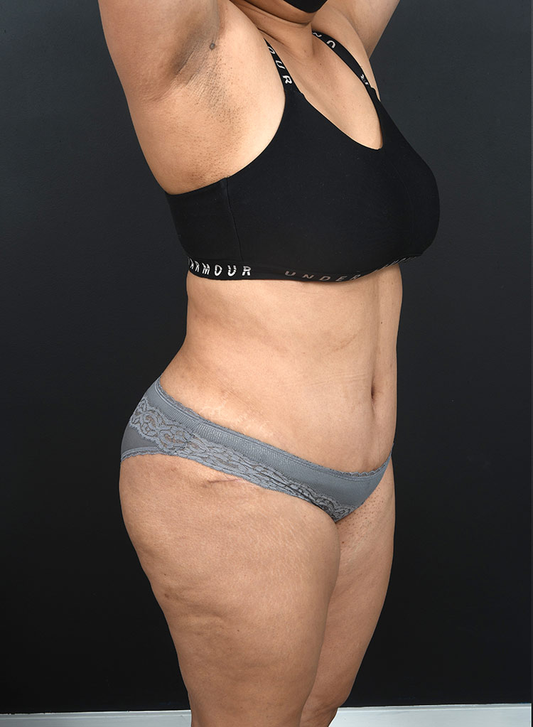 Female body, after Abdominoplasty treatment, r-side oblique view, patient 13
