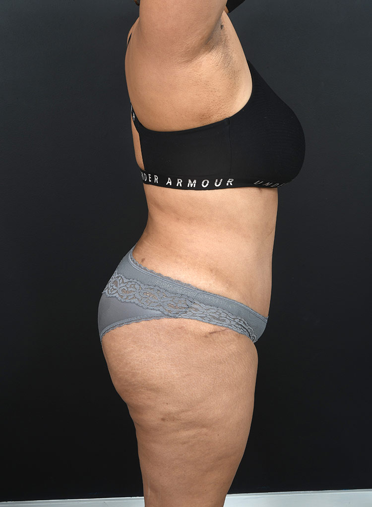 Female body, after Abdominoplasty treatment, r-side view, patient 13