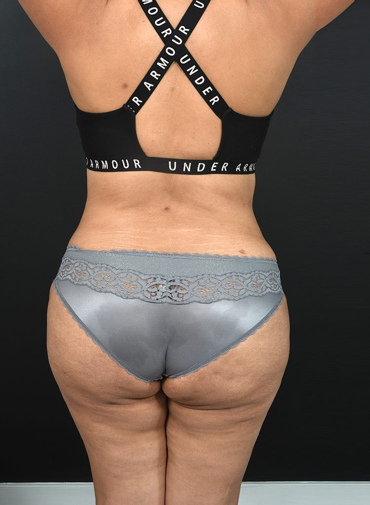 Female body, after Abdominoplasty treatment, back side view, patient 13