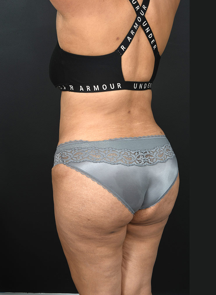 Female body, after Abdominoplasty treatment, back side oblique view, patient 13