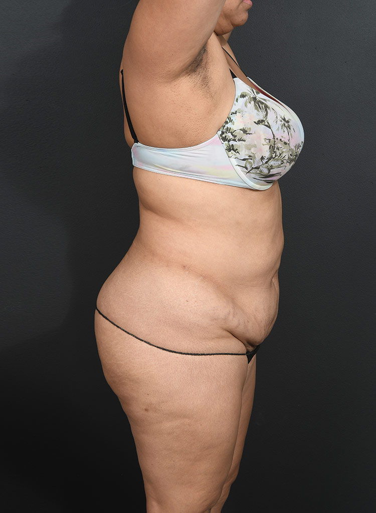 Female body, before Abdominoplasty treatment, r-side view, patient 13