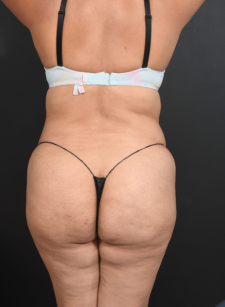 Female body, before Abdominoplasty treatment, back side view, patient 13