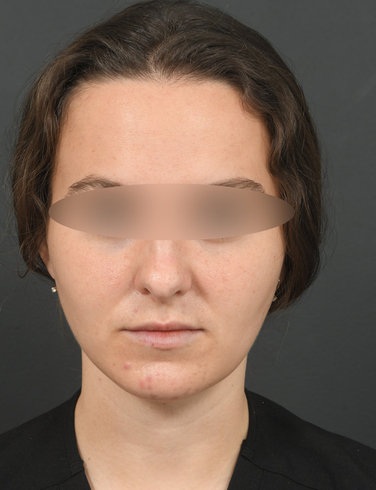 Female face, after BUCCAL FAT REMOVAL treatment, front view, patient 2