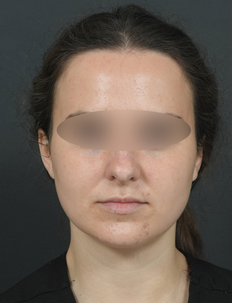 Female face, before BUCCAL FAT REMOVAL treatment, front view, patient 2